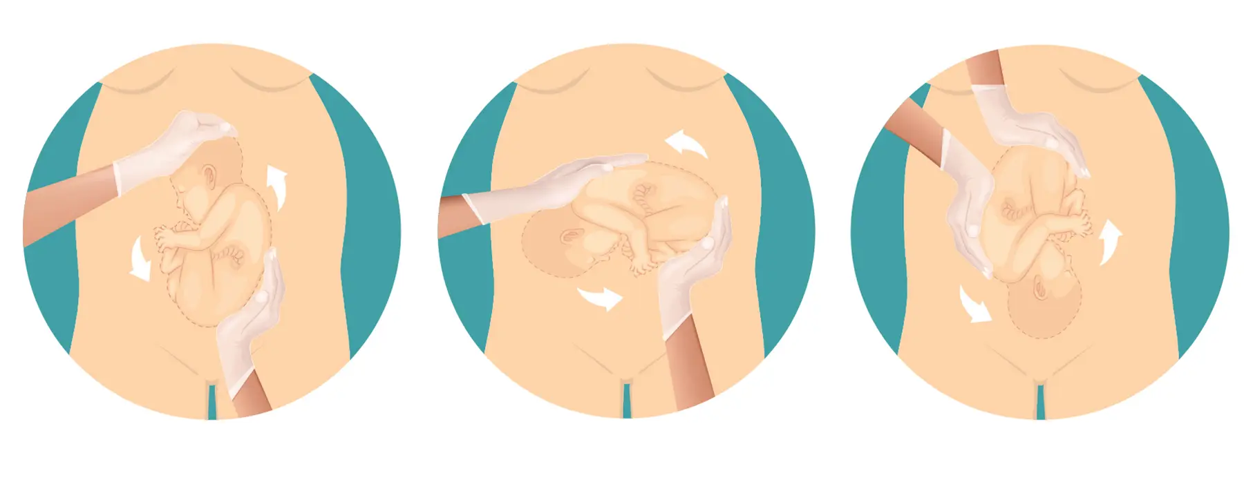 example-of-External-Cephalic-Version