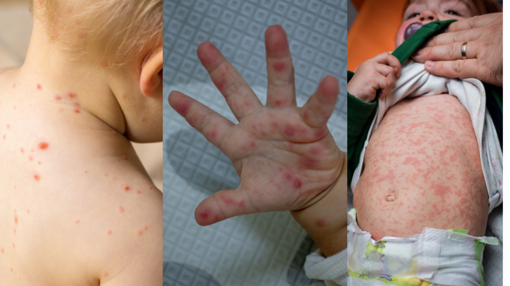 baby skin disease